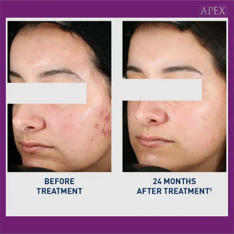 ก่อนและหลังทำ Accure Laser