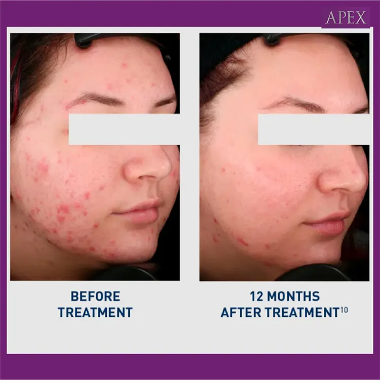 ก่อนและหลังทำ Accure Laser