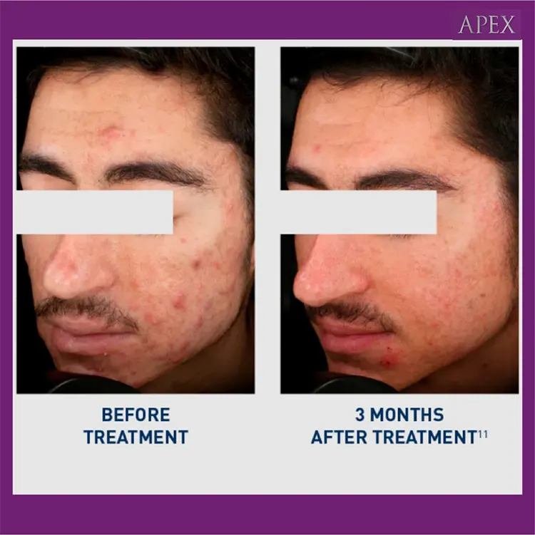 ก่อนและหลังทำ Accure Laser