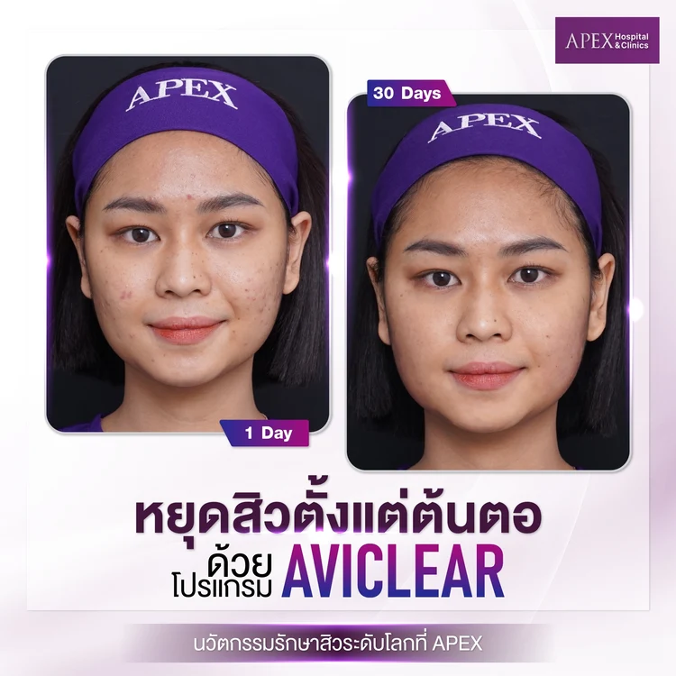 AviClear Laser รีวิว