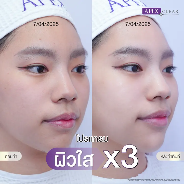 Pico Toning ก่อนและหลังทำ