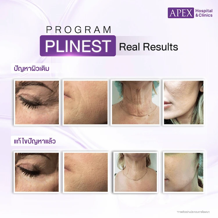 Plinest ผลลัพธ์