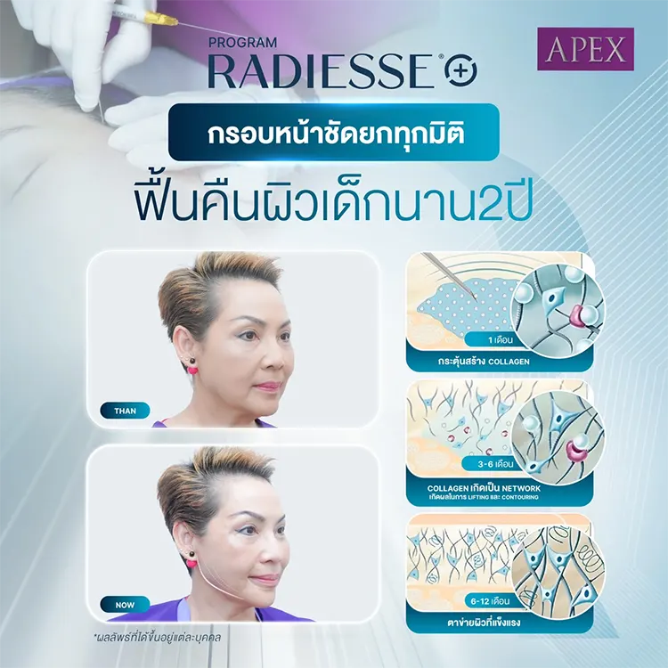 Radiesse Plus ช่วยอะไร