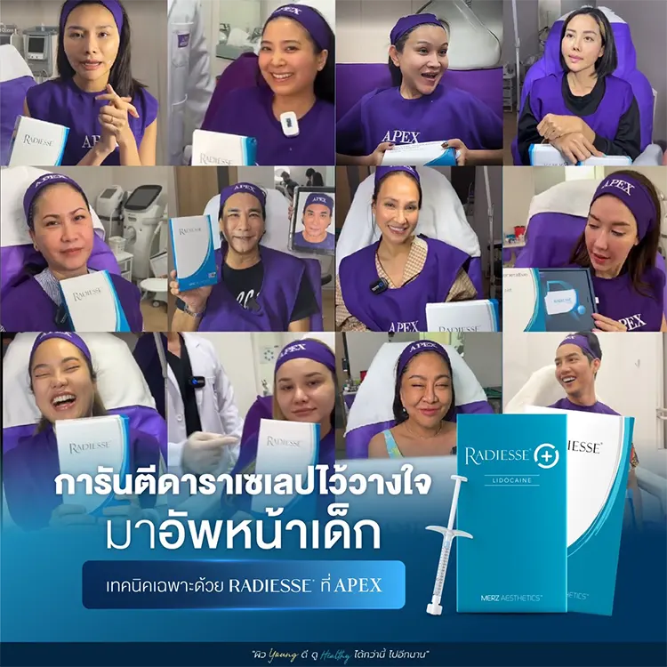 รีวิวหลังฉีด Radiesse Plus