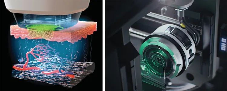 Reepot Laser