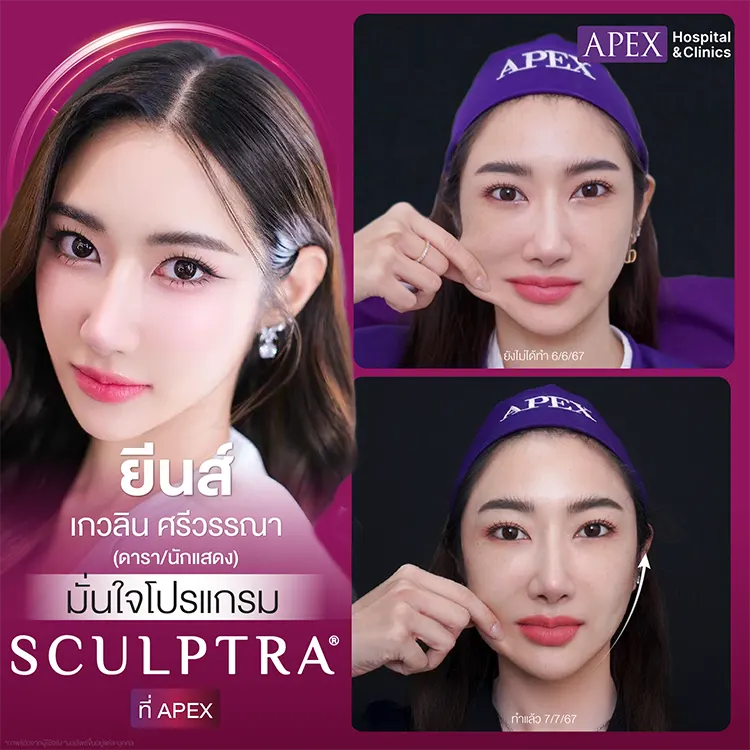 รีวิว Sculptra