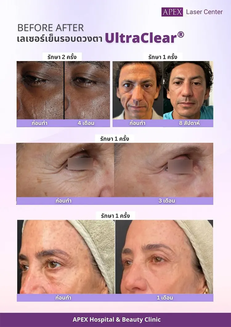 รีวิว UltraClear