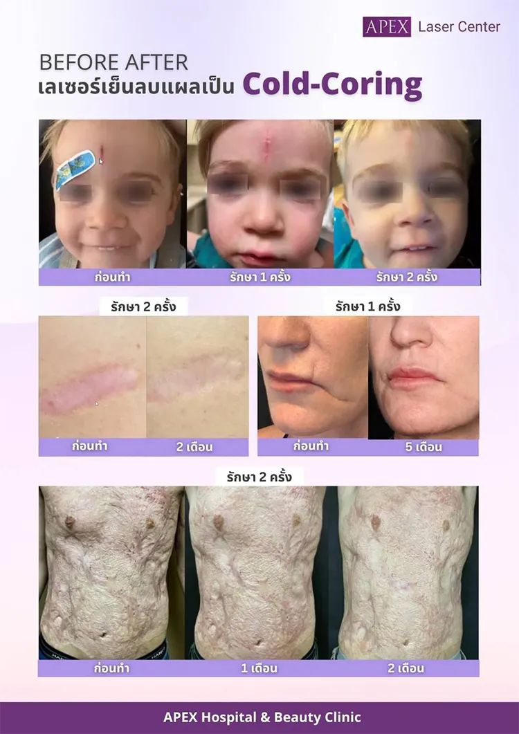 รีวิว UltraClear