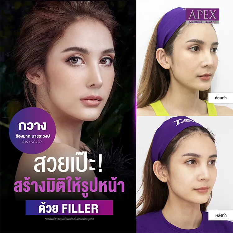 ฉีดฟิลเลอร์ขมับ รีวิว