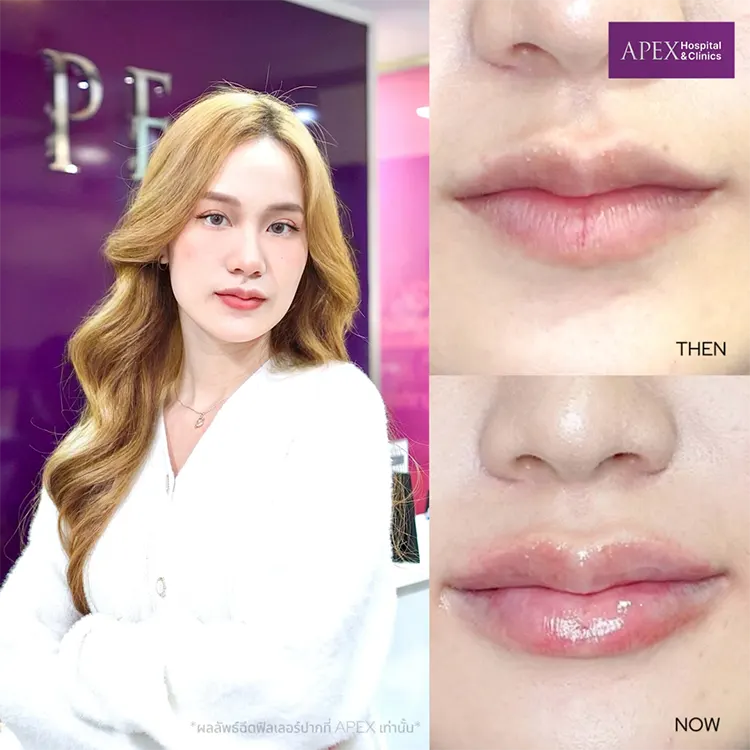 ฉีดฟิลเลอร์ยกมุมปาก รีวิว