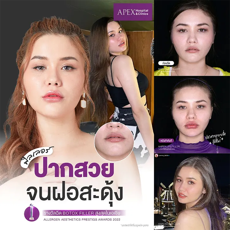 ทรงปาก ฉีดฟิลเลอร์ยกมุมปาก