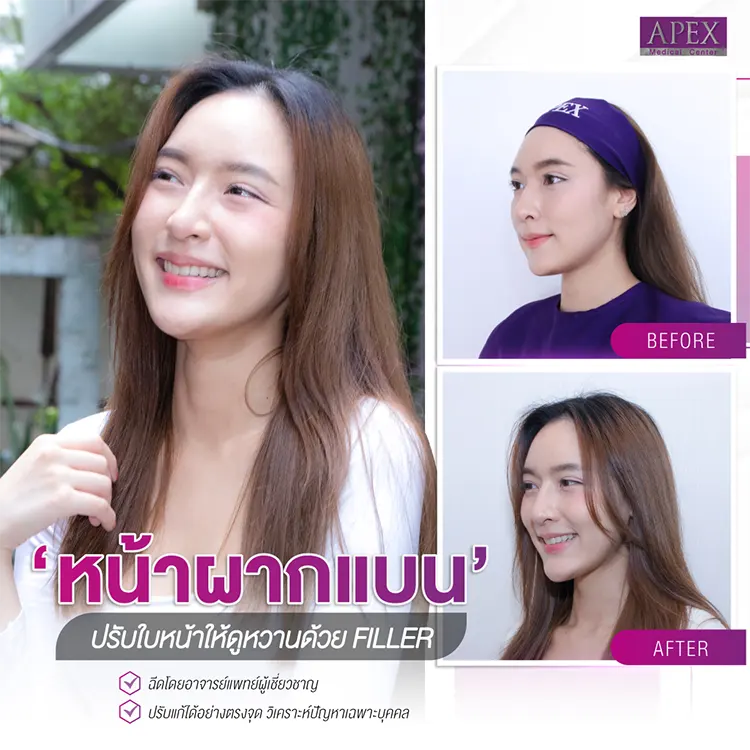 ฉีดฟิลเลอร์หน้าผาก แก้หน้าผากแบน