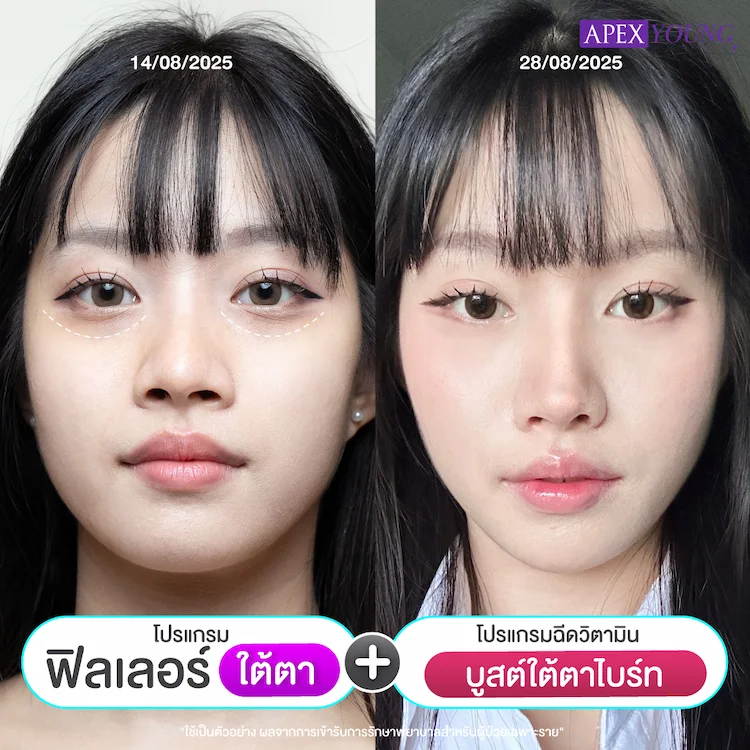 รีวิว ฉีดฟิลเลอร์ใต้ตา