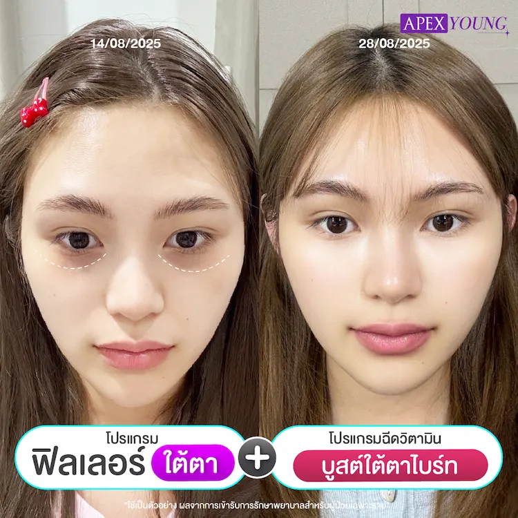 รีวิว ฉีดฟิลเลอร์ใต้ตา