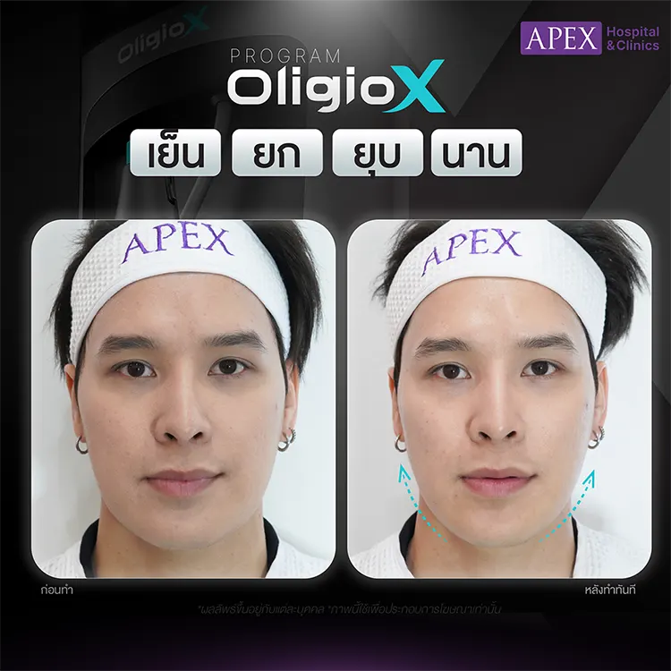 รีวิว Oligio X