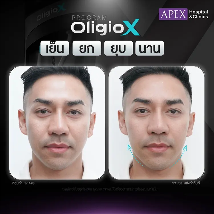 รีวิว Oligio X