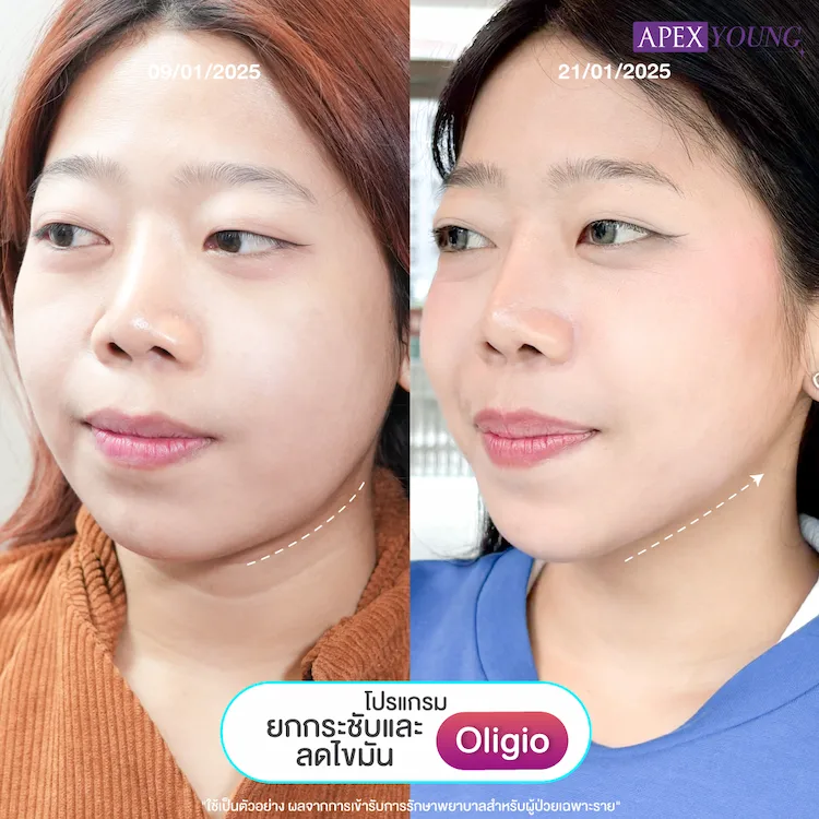 รีวิว Oligio