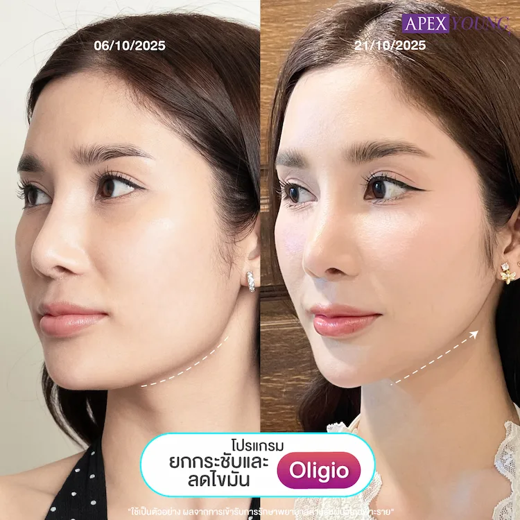 รีวิว Oligio