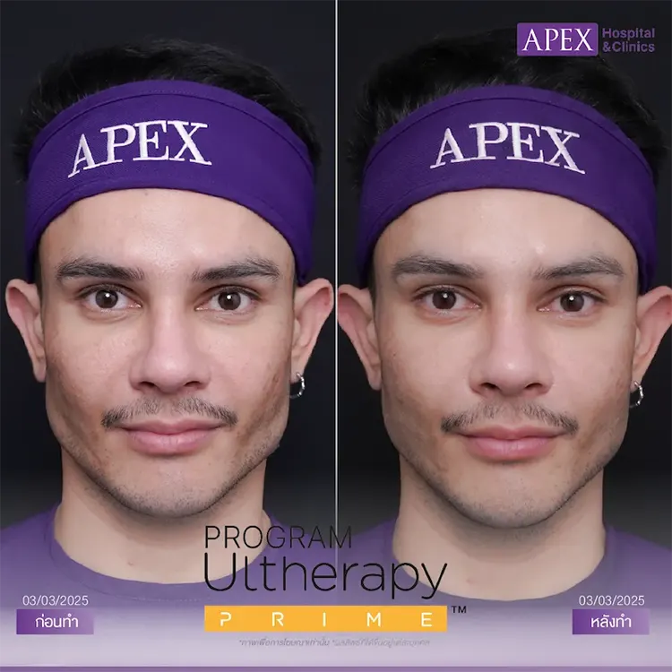รีวิว Ultherapy Prime