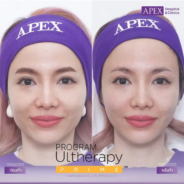 รีวิว Ultherapy Prime
