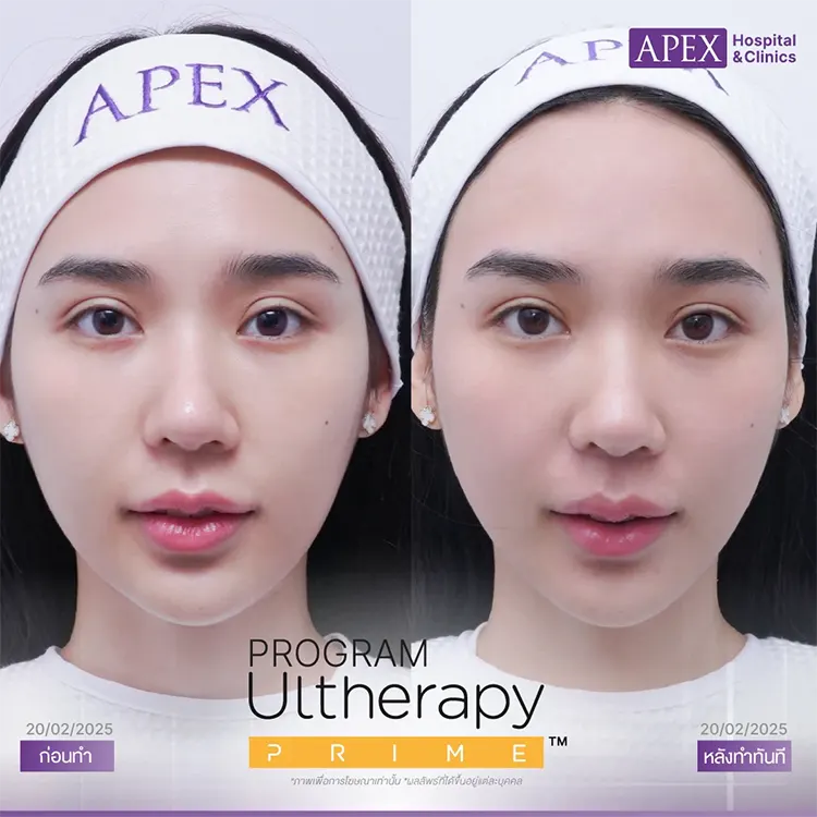 รีวิว Ultherapy Prime
