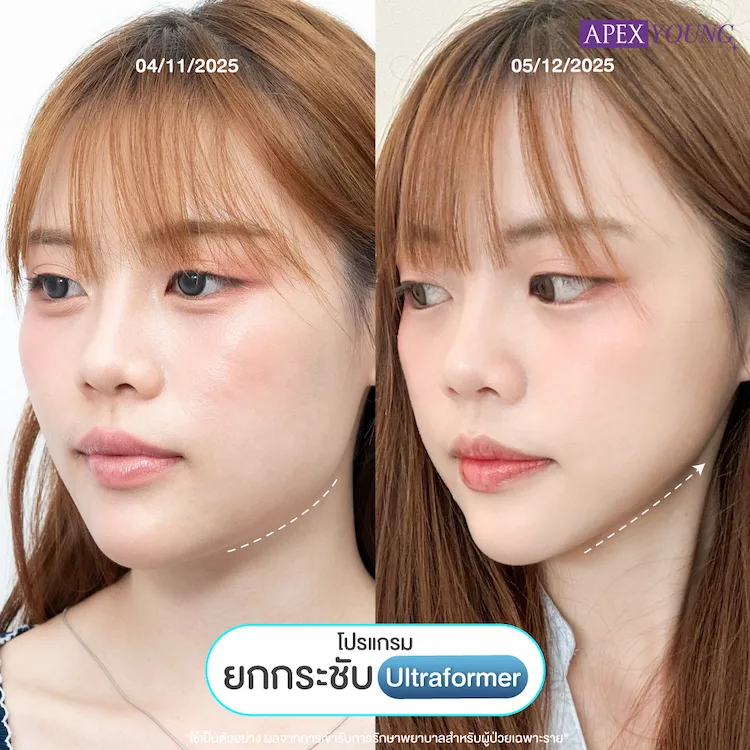 รีวิว Ultraformer