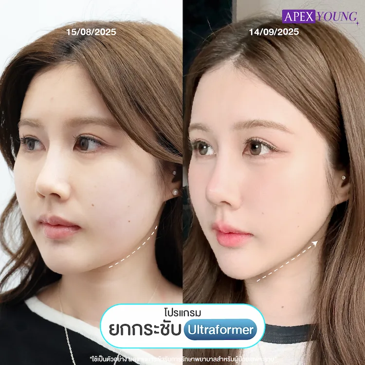 รีวิว Ultraformer