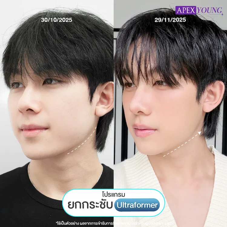 รีวิว Ultraformer