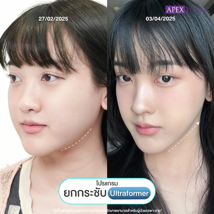 รีวิว Ultraformer