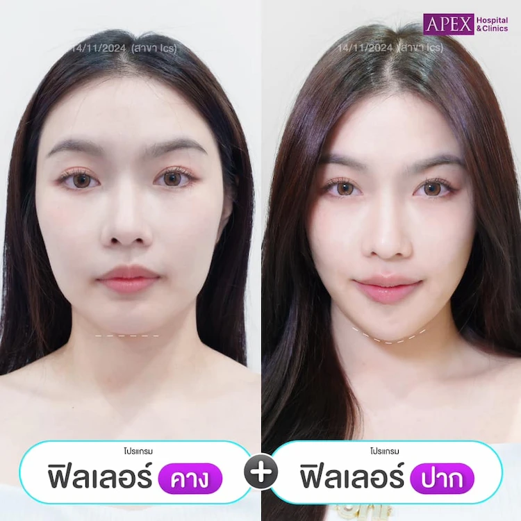 รีวิว ฉีดฟิลเลอร์คาง