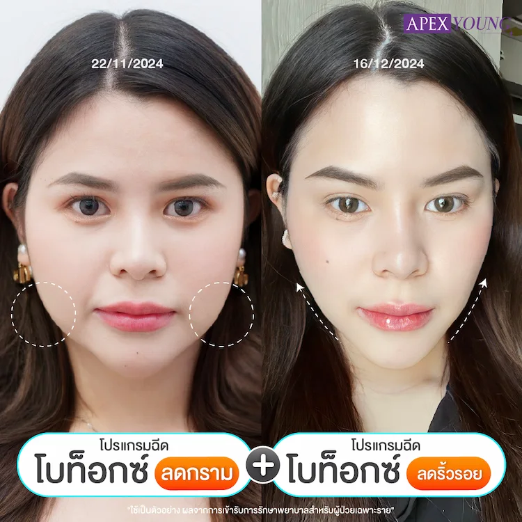 รีวิว ฉีดโบท็อก
