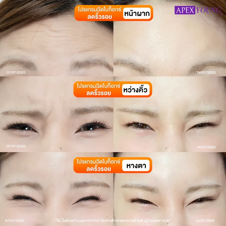 รีวิว ฉีดโบลดริ้วรอย