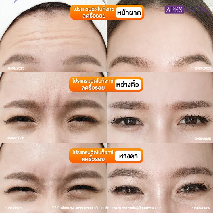 รีวิว ฉีดโบท็อก