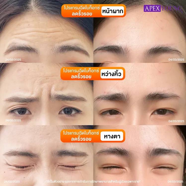 รีวิว ฉีดโบลดริ้วรอย