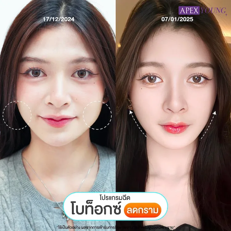 รีวิว ฉีดโบท็อกกราม