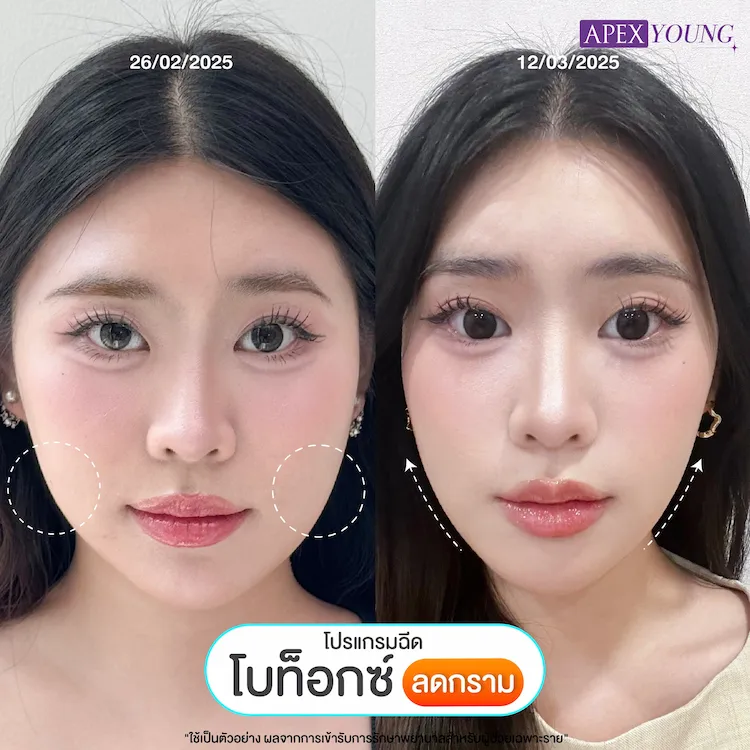 รีวิว ฉีดโบท็อกกราม
