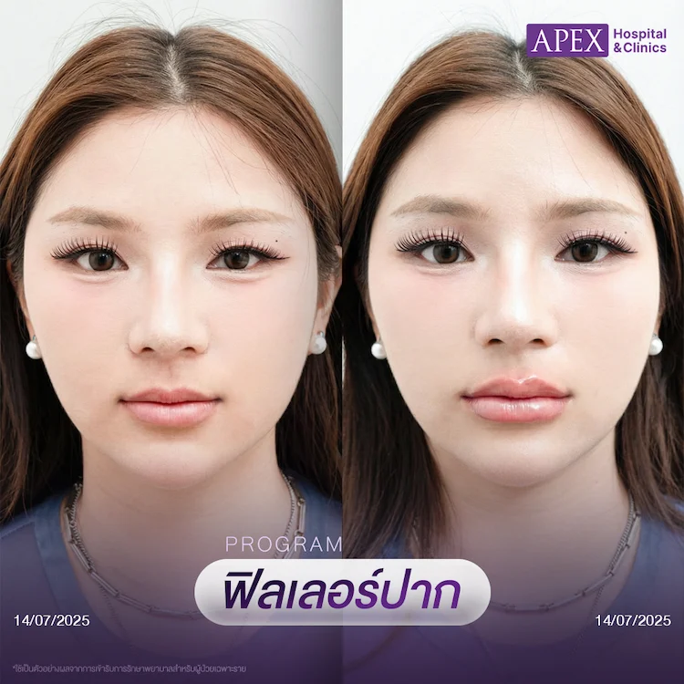 รีวิว ฉีดฟิลเลอร์ปาก