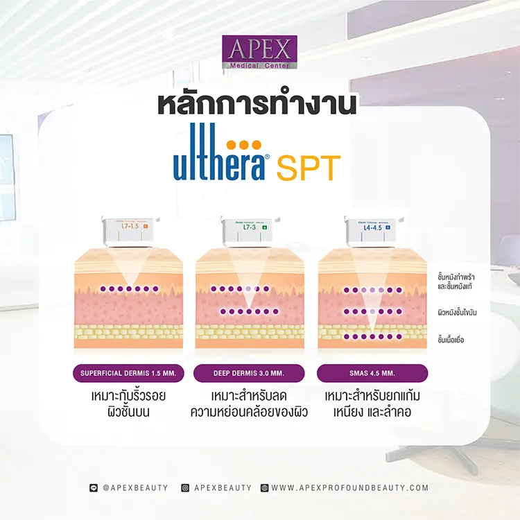 หลักการทำงานของ Ulthera