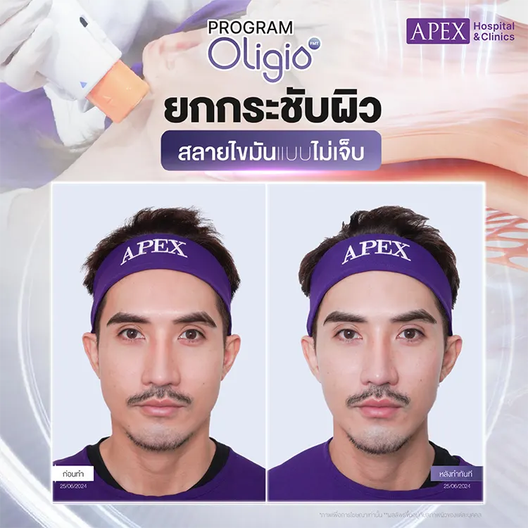 หลังทำ Oligio