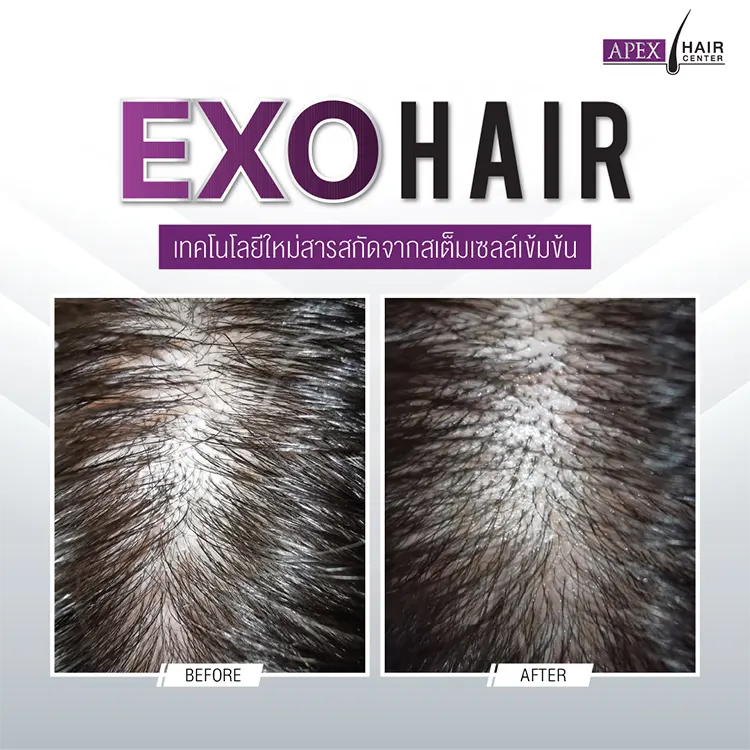 EXO HAIR รีวิว