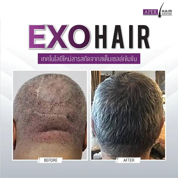 EXO HAIR รีวิว