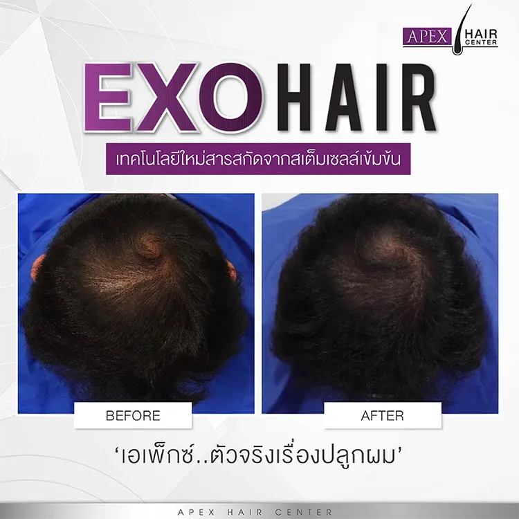 EXO HAIR รีวิว