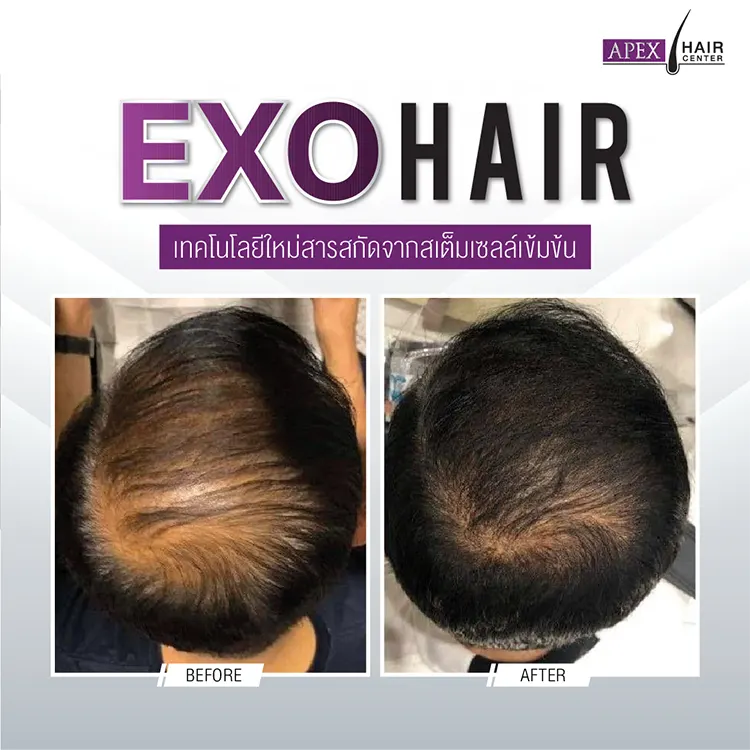 EXO HAIR รีวิว