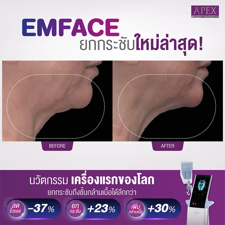 Emface รีวิว