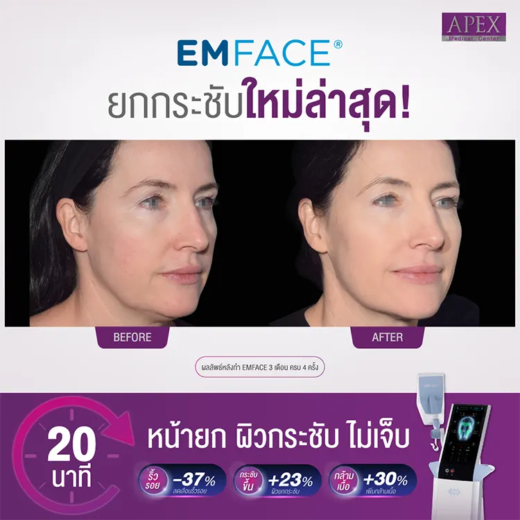 Emface รีวิว