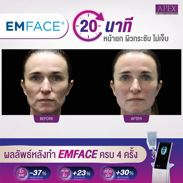 Emface รีวิว
