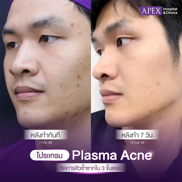 Plasma Acne รีวิว