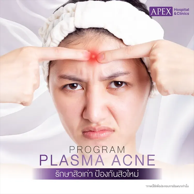 Plasma Acne