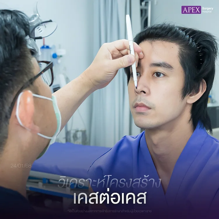 ก่อนเสริมจมูก