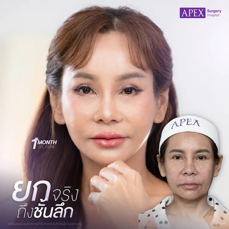 ดึงหน้า เหมาะกับใคร